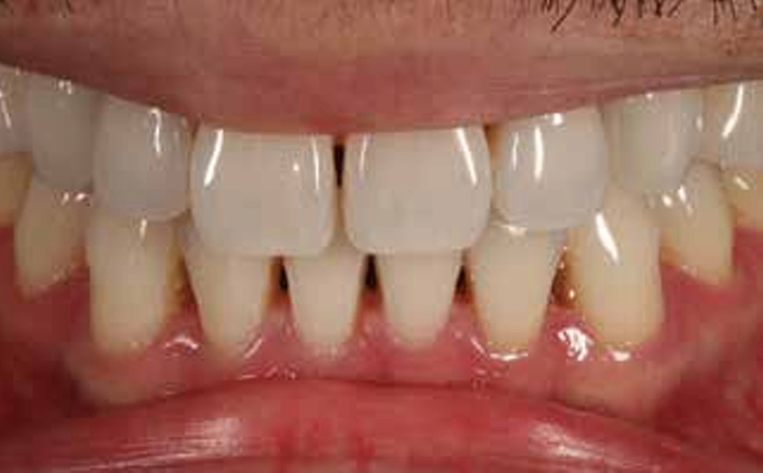 Patient with Black Triangles