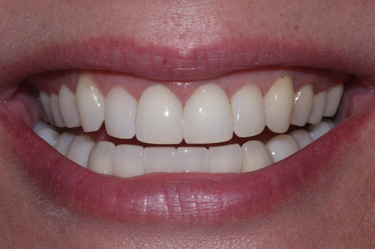Why the Bioclear Anatomical Mylar Matrix is Transforming Restorative Dentistry - www.bioclearmatrix.co.uk
