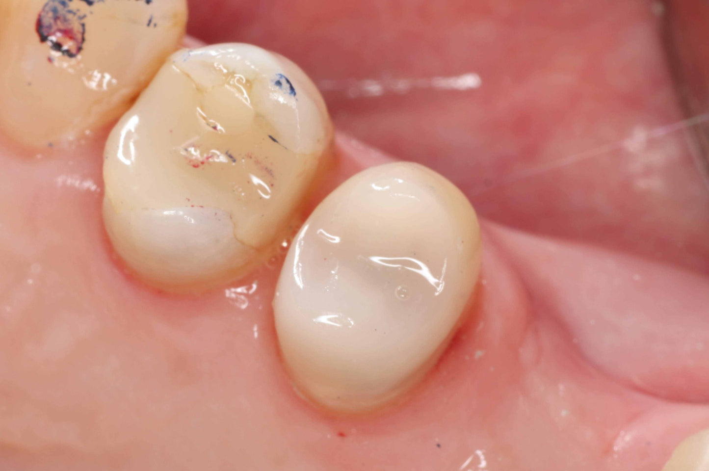 Summit - Premolar Snapoff Workshop