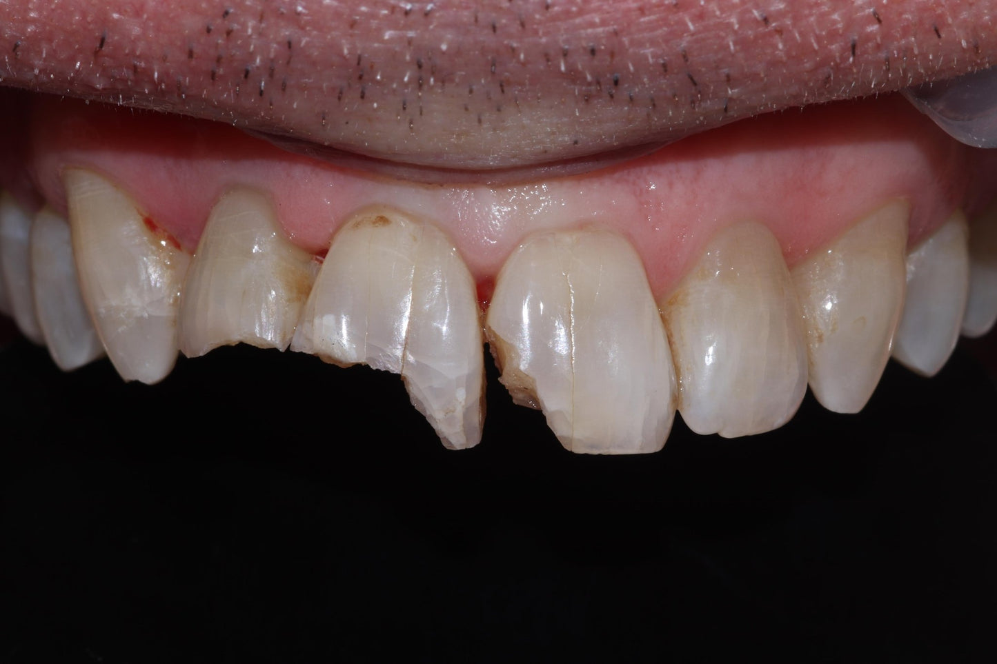 Bioclear Complete Anterior Composite Course - www.bioclearmatrix.co.uk CORE - 13 DHTI