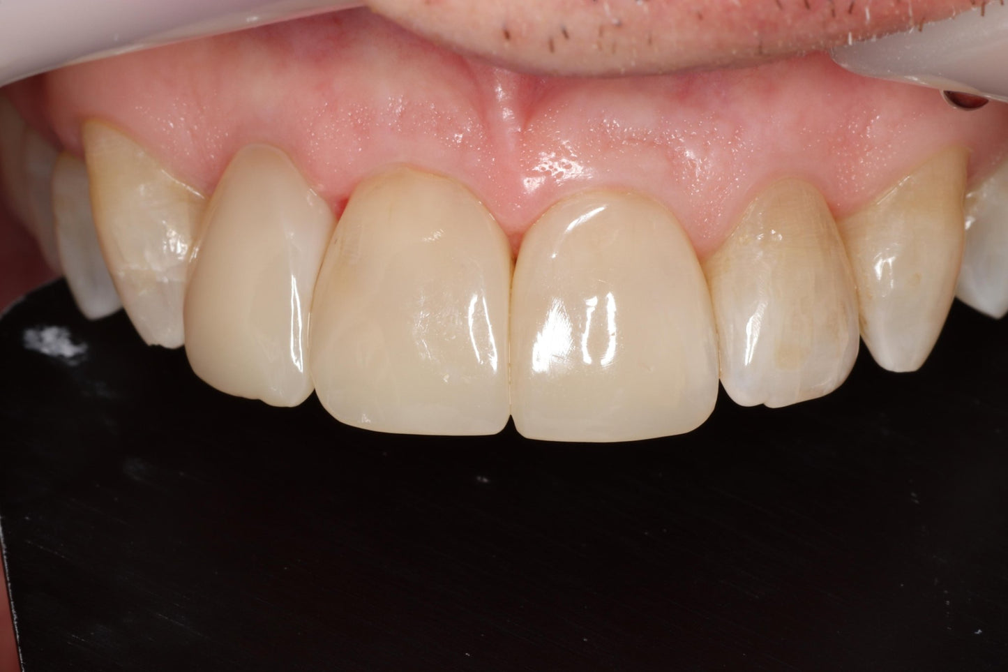 Bioclear Complete Anterior Composite Course - www.bioclearmatrix.co.uk CORE - 13 DHTI