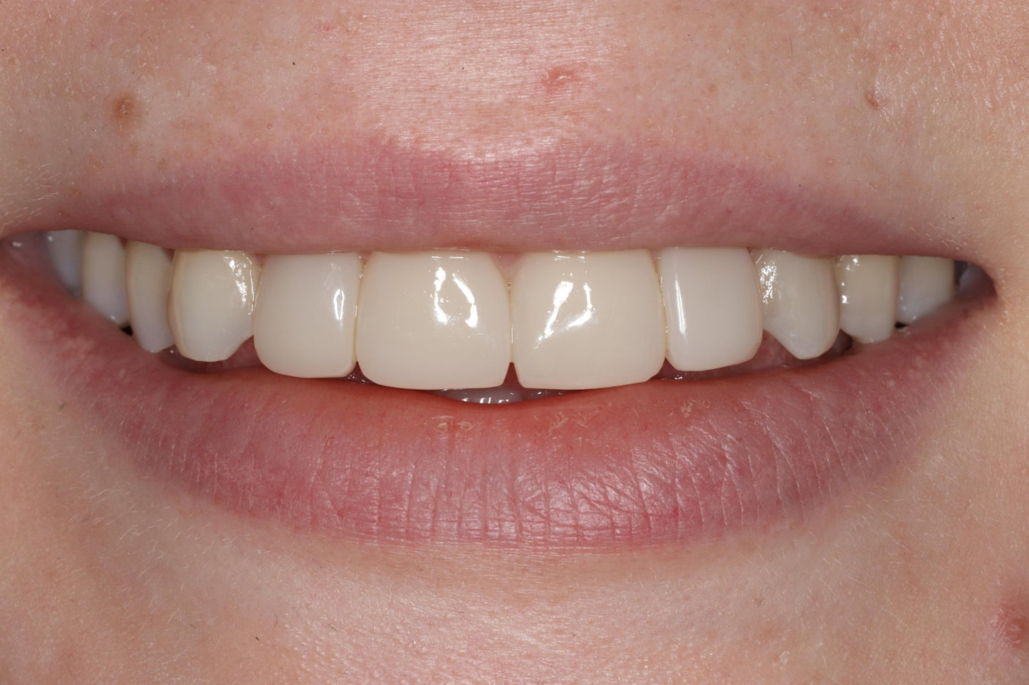Bioclear Complete Anterior Composite Course - www.bioclearmatrix.co.uk CORE - 13 DHTI