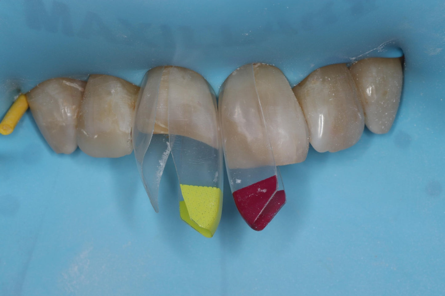 Bioclear Complete Anterior Composite Course - www.bioclearmatrix.co.uk CORE - 13 DHTI