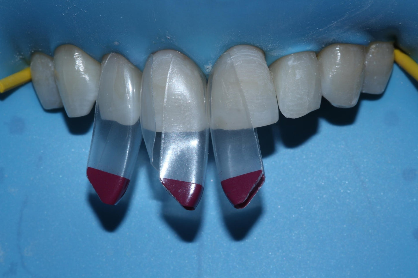 Bioclear Complete Anterior Composite Course - www.bioclearmatrix.co.uk CORE - 13 DHTI