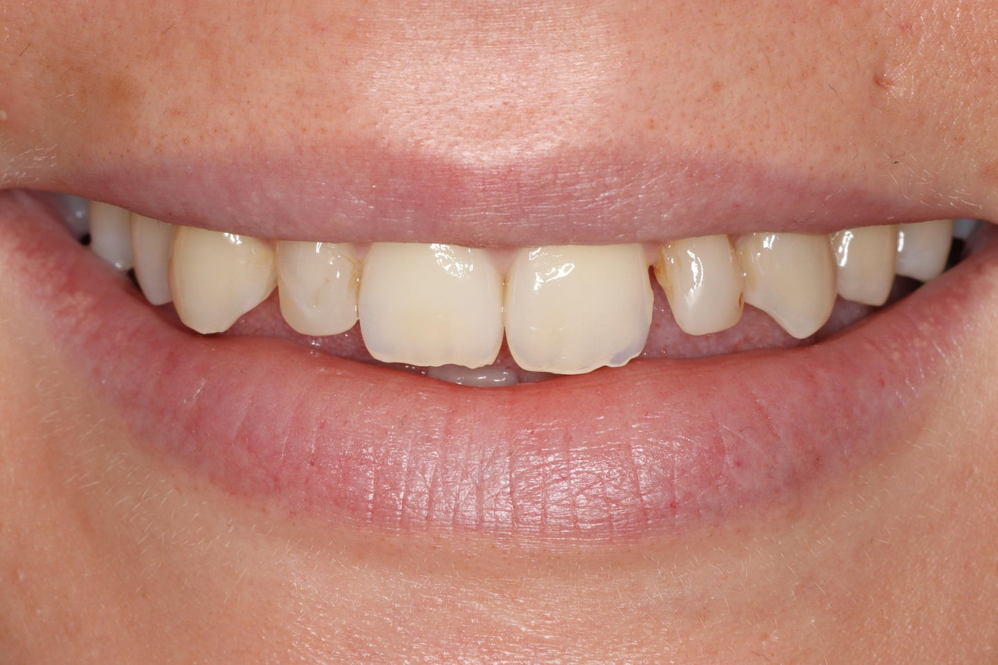 Bioclear Complete Anterior Composite Course - www.bioclearmatrix.co.uk CORE - 13 DHTI