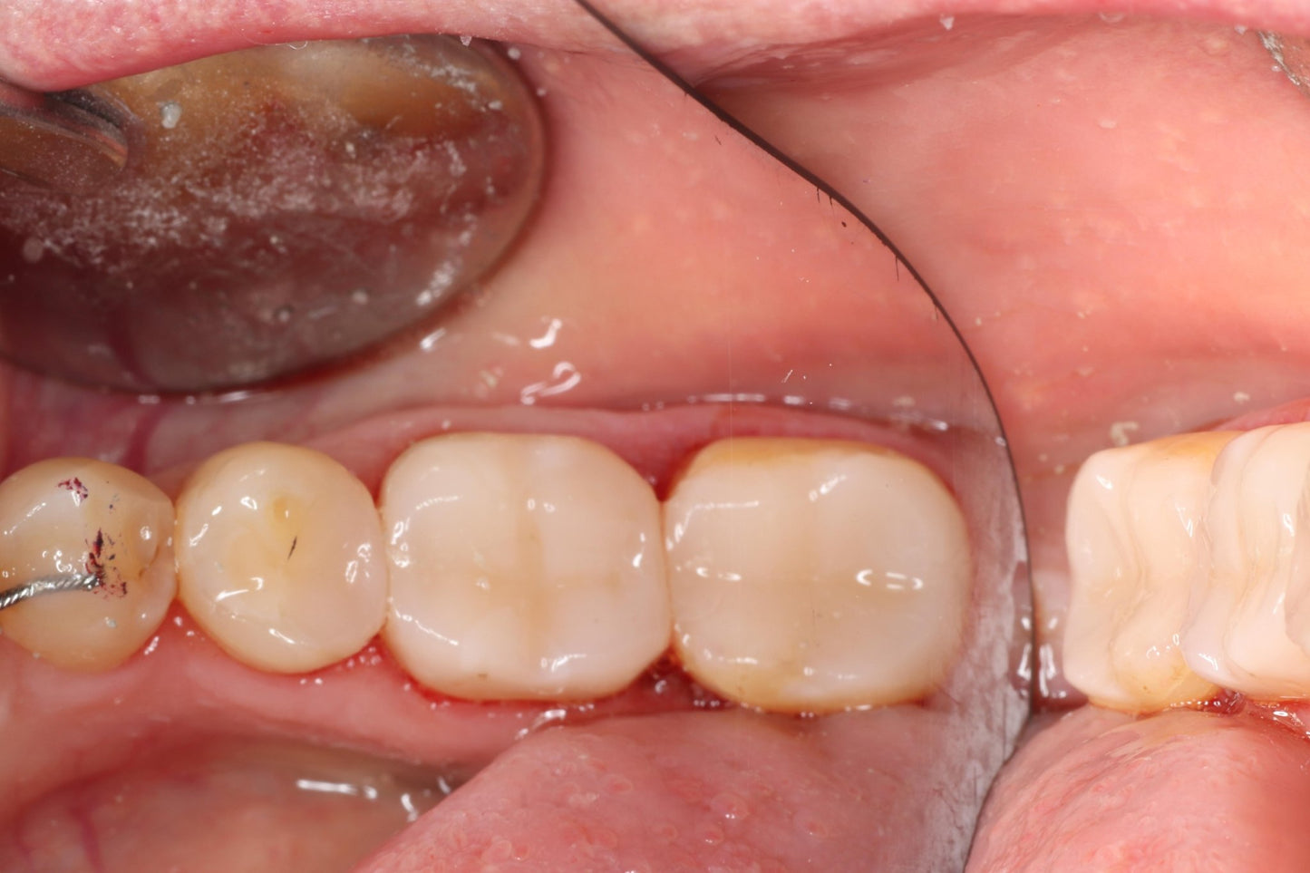 Bioclear Complete Posterior Composite Course - www.bioclearmatrix.co.uk CORE - 24 DHTI