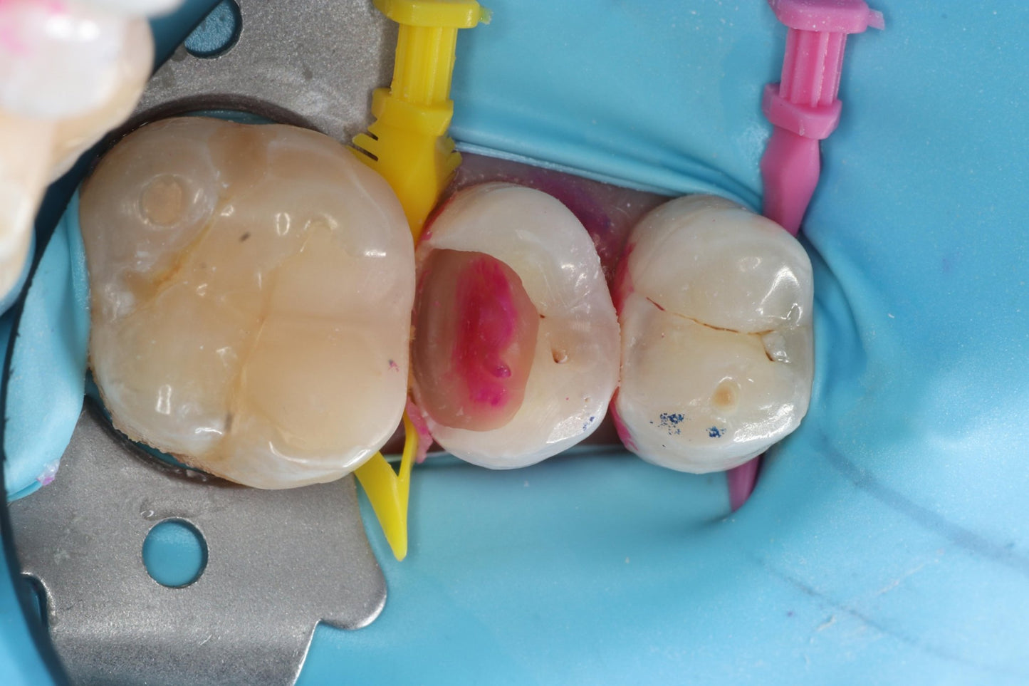Bioclear Complete Posterior Composite Course - www.bioclearmatrix.co.uk CORE - 24 DHTI