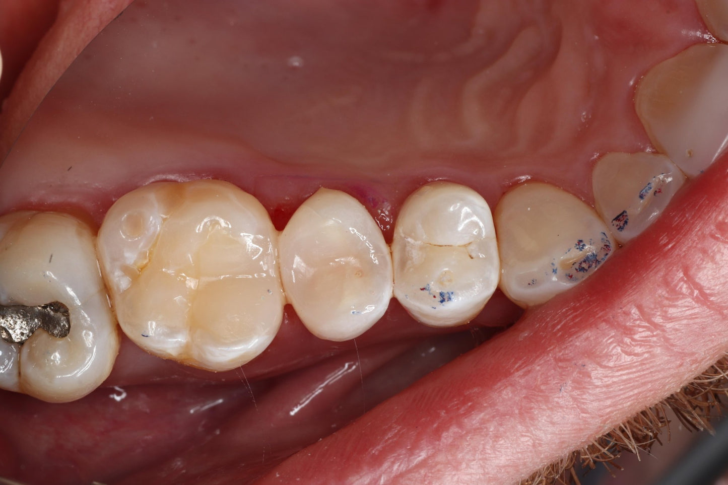 Bioclear Complete Posterior Composite Course - www.bioclearmatrix.co.uk CORE - 24 DHTI