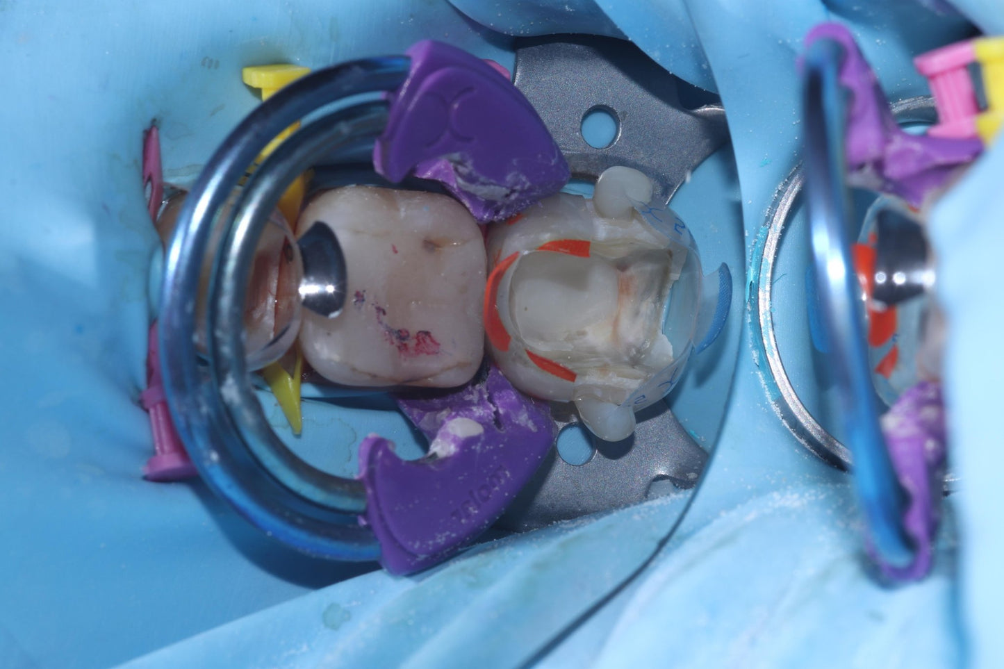 Bioclear Complete Posterior Composite Course - www.bioclearmatrix.co.uk CORE - 24 DHTI