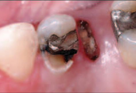 The Epidemic of Cracked and Fracturing Teeth by Dr Clark