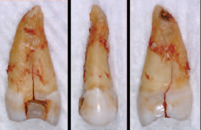 Fracture-Resistant Endodontic and Restorative Preparations by Drs' Clark, Khademi and Herbranson