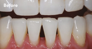 Unsightly black triangles, a tricky restorative procedure made easy with flowable composites and warming