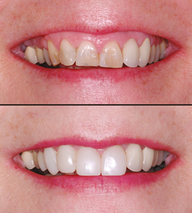 Composite vs. Porcelain: What You Need to Know By Dr. David Clark