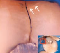 Definitive Diagnosis of Early Enamel and Dentinal Cracks based on Microscopic Evaluation by Dr Clark