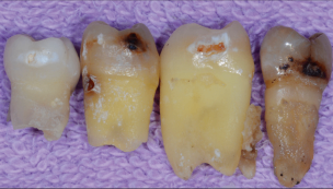 Modern Cavity Preparations Tucker Gold and Clark Class II by Dr Clark