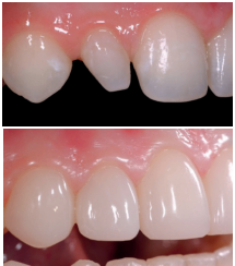 Dental Updates Black Triangle Article By Dr Claire Burgess and Prof Dominic Hassall