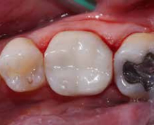 Dental Update Posterior Article By Dr Burgess and Prof Dominic Hassall
