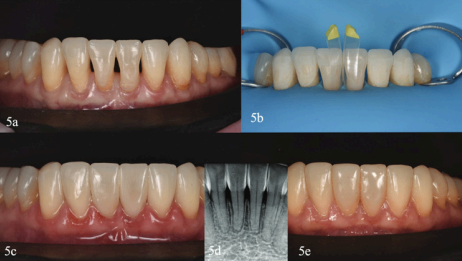 Minimally Invasive Cosmetic Restoration with Open Gingival Embrasures Compressed