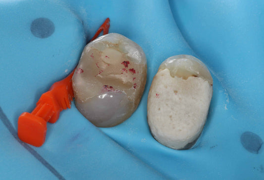 Summit - Premolar Snapoff Workshop