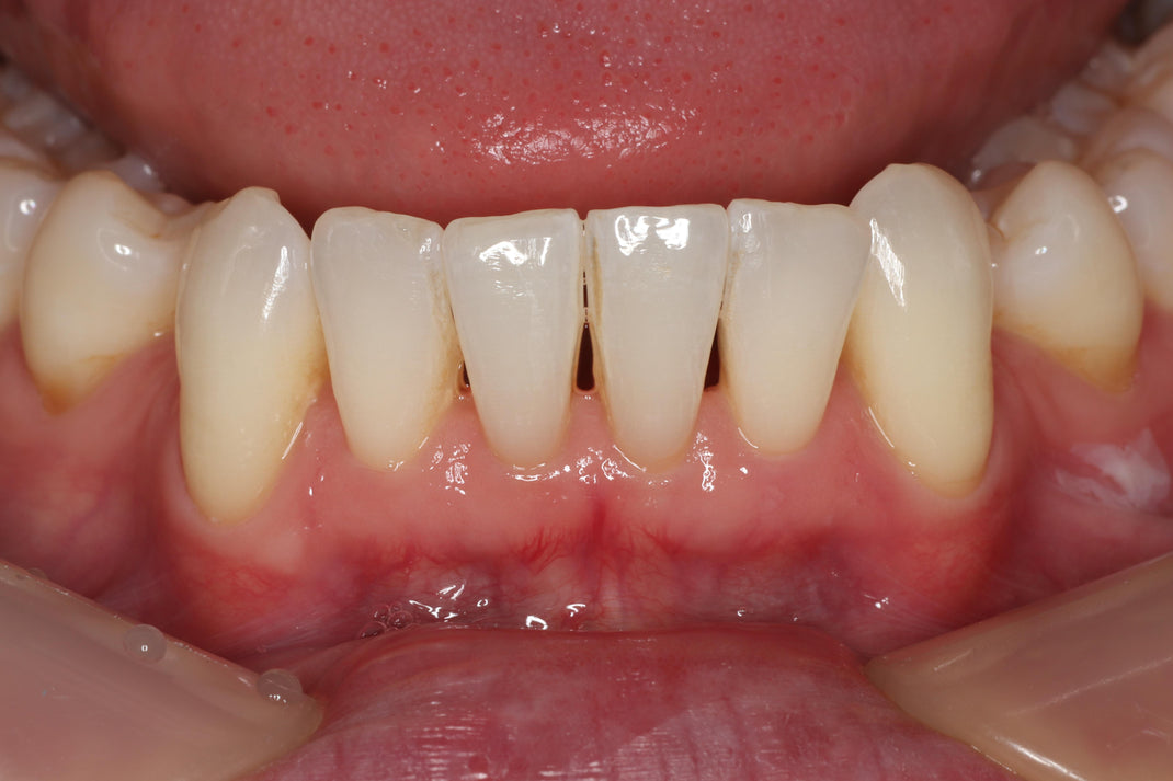 Lower Black Triangle Closure following Orthodontics - J. M Sept 2024 ...