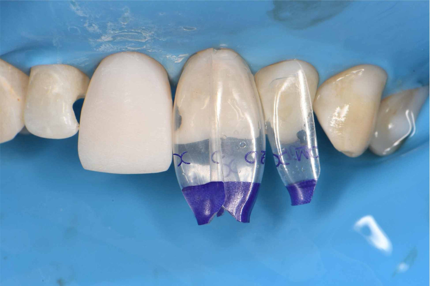 Summit - TSS Incisor Workshop