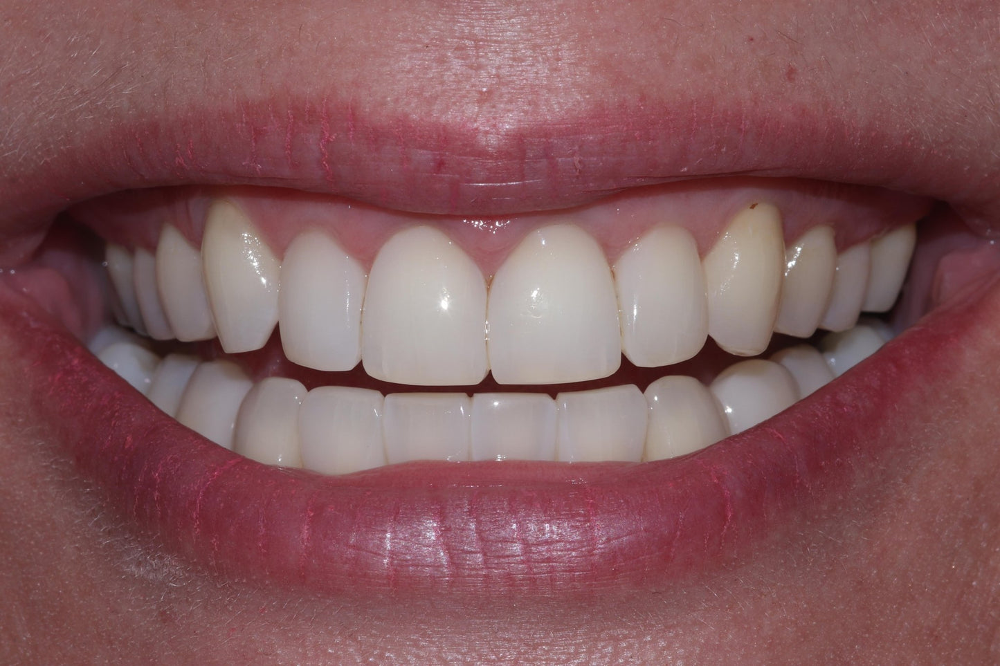 Bioclear Complete Anterior Composite Course - www.bioclearmatrix.co.uk CORE - 13 DHTI
