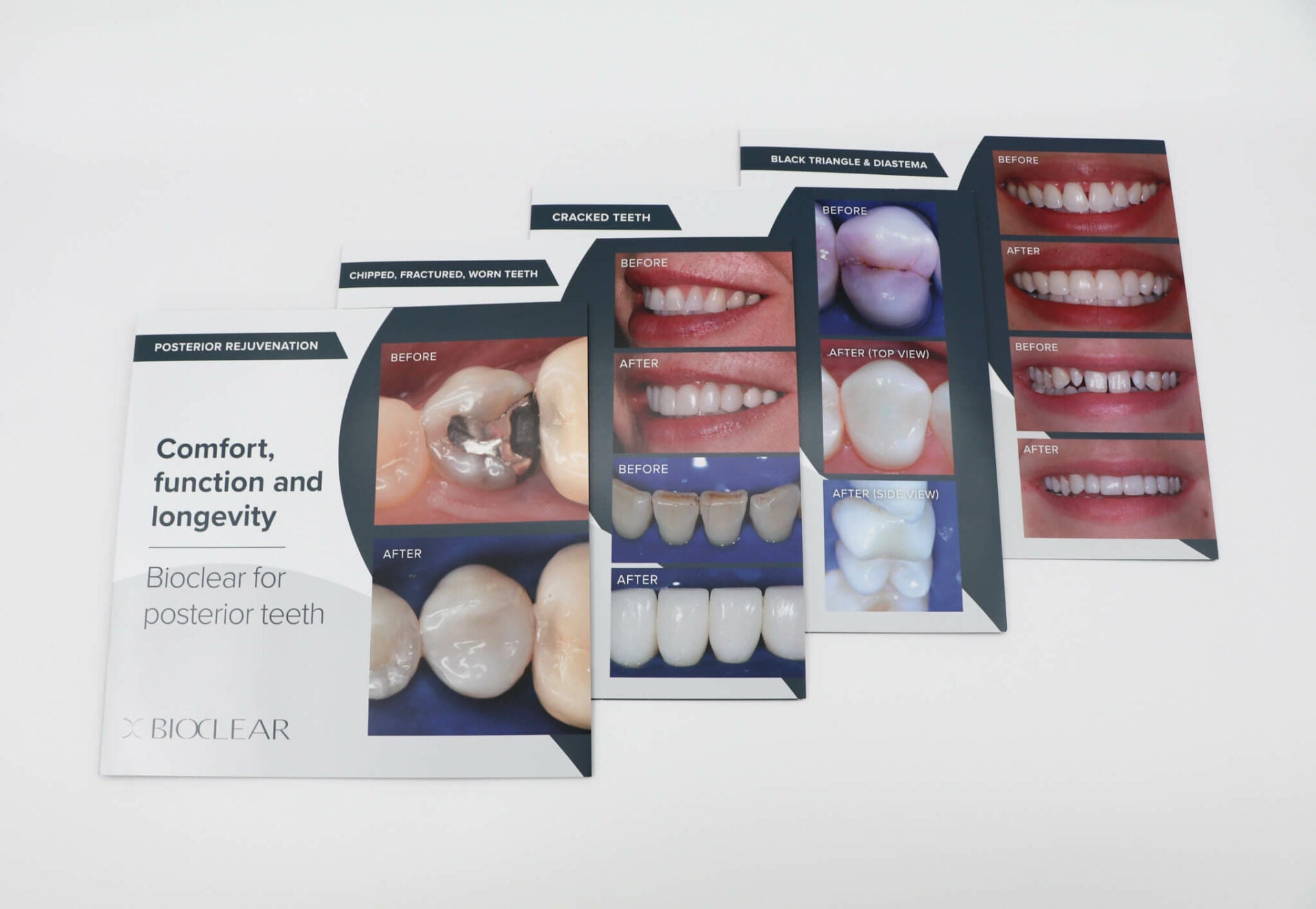 Bioclear Matrix UK | Bioclear Matrices, Wedges & Dental Composite ...