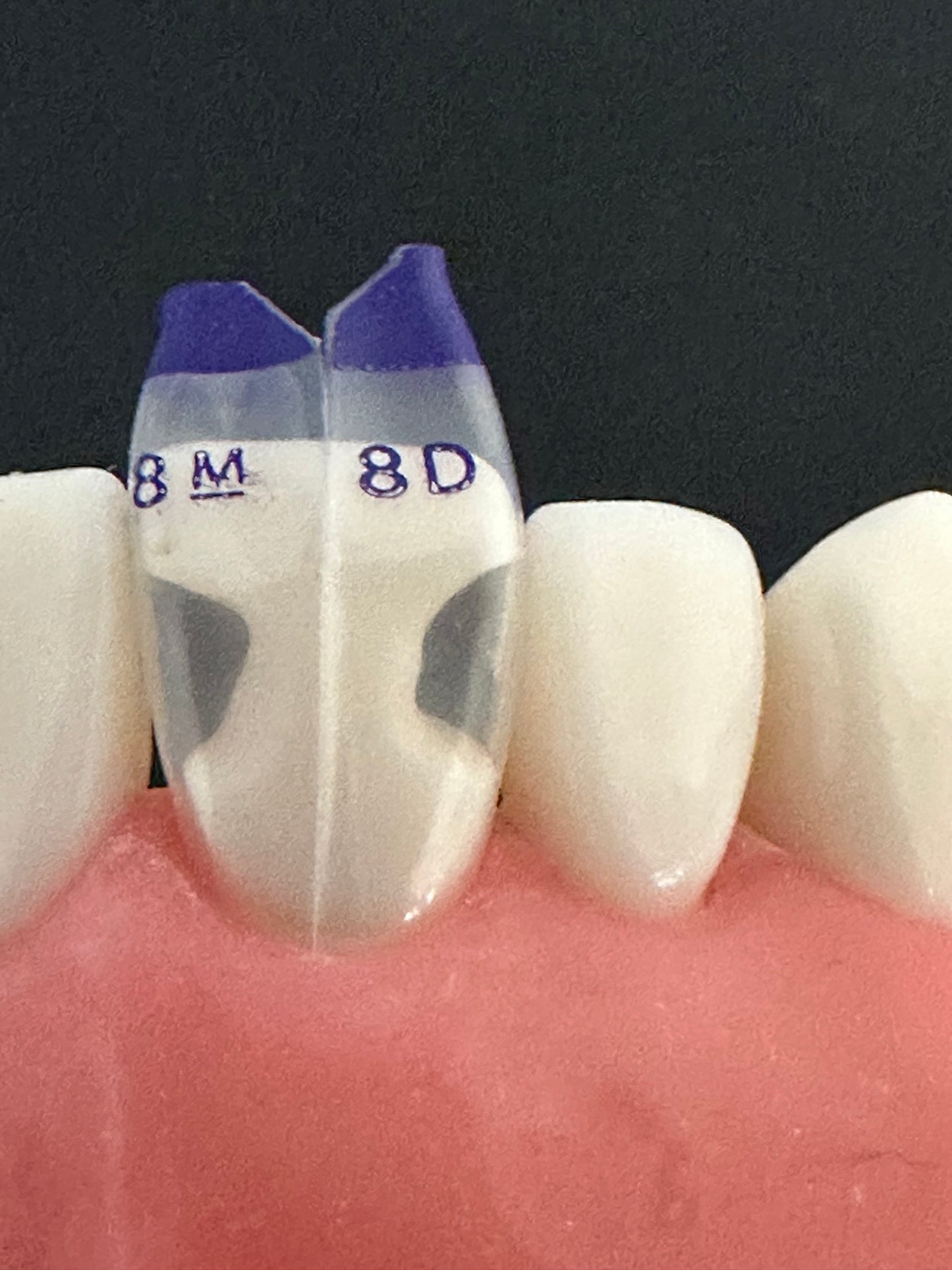 Summit - TSS Incisor Workshop